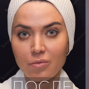 Удаление розацеи Candela Vbeam Perfecta