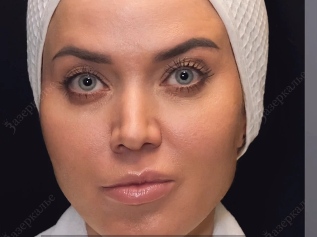 Удаление розацеи Candela Vbeam Perfecta
