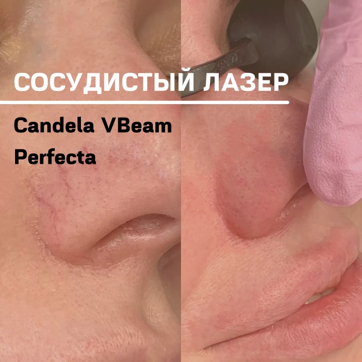 Сосудистый лазер Candela Vbeam Perfecta