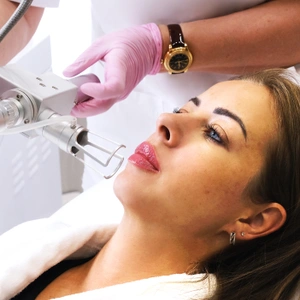 Лазерная шлифовка лица на аппарате СО2