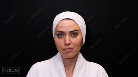 Удаление розацеи Candela Vbeam Perfecta