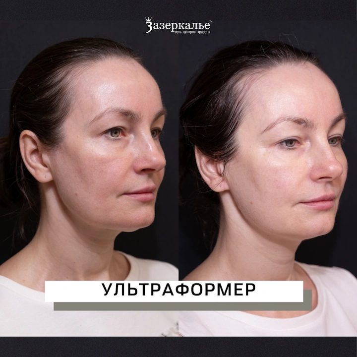 SMAS-лифтинг на аппарате Ultraformer III