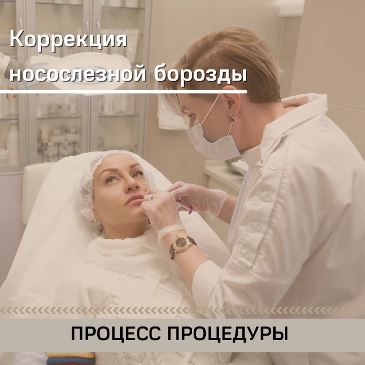 Коррекция носослезной борозды
