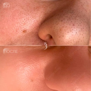 Чистка лица 