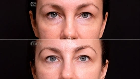 SMAS-лифтинг на аппарате Ultraformer III