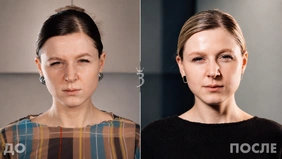 Ботулинотерапия "Диспорт"