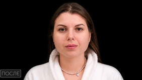 Контурная пластика губ