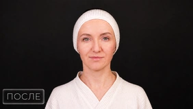 Биореструктуризация кожи лица коллагеном Nithya