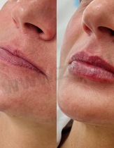 До/после контурная пластика губ с помощью препарата Juvederm ULTRA Smile. Работа врача-косметолога Петрушовой Алены Анатольевны