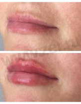 До/после контурной пластики губ. Фотография "после" сделана сразу же после процедуры, присутствует краснота и небольшой отек