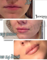 Контурная пластика губ, препарат Juvederm Ultra smile. Работа врача-косметолога Даниловой Яны Евгеньевны