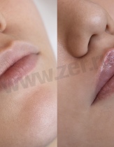 До/после контурной пластики губ. Препарат: Juvederm retouch