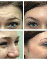 Результат до и после инъекций Ботокс для устранения морщин на лбу и вокруг глаз