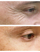Инъекции диспорта для устранение морщин на лбу и вокруг глаз: фото до и после