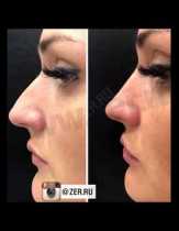 коррекция носа, коррекция подбородка, коррекция носогубных складок, увеличение губ