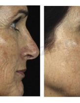 Лазерное лечение пигментных нарушений кожи