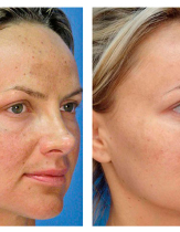 Лазерное лечение пигментных нарушений кожи на лице