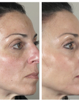 Лазерное лечение пигментных нарушений кожи на лице