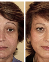 Подтяжка лица с помощью нитей Aptos. Фотография до и после процедуры.