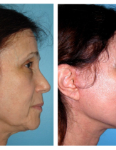 Подтяжка лица с помощью нитей Aptos. Фотография до и после процедуры.